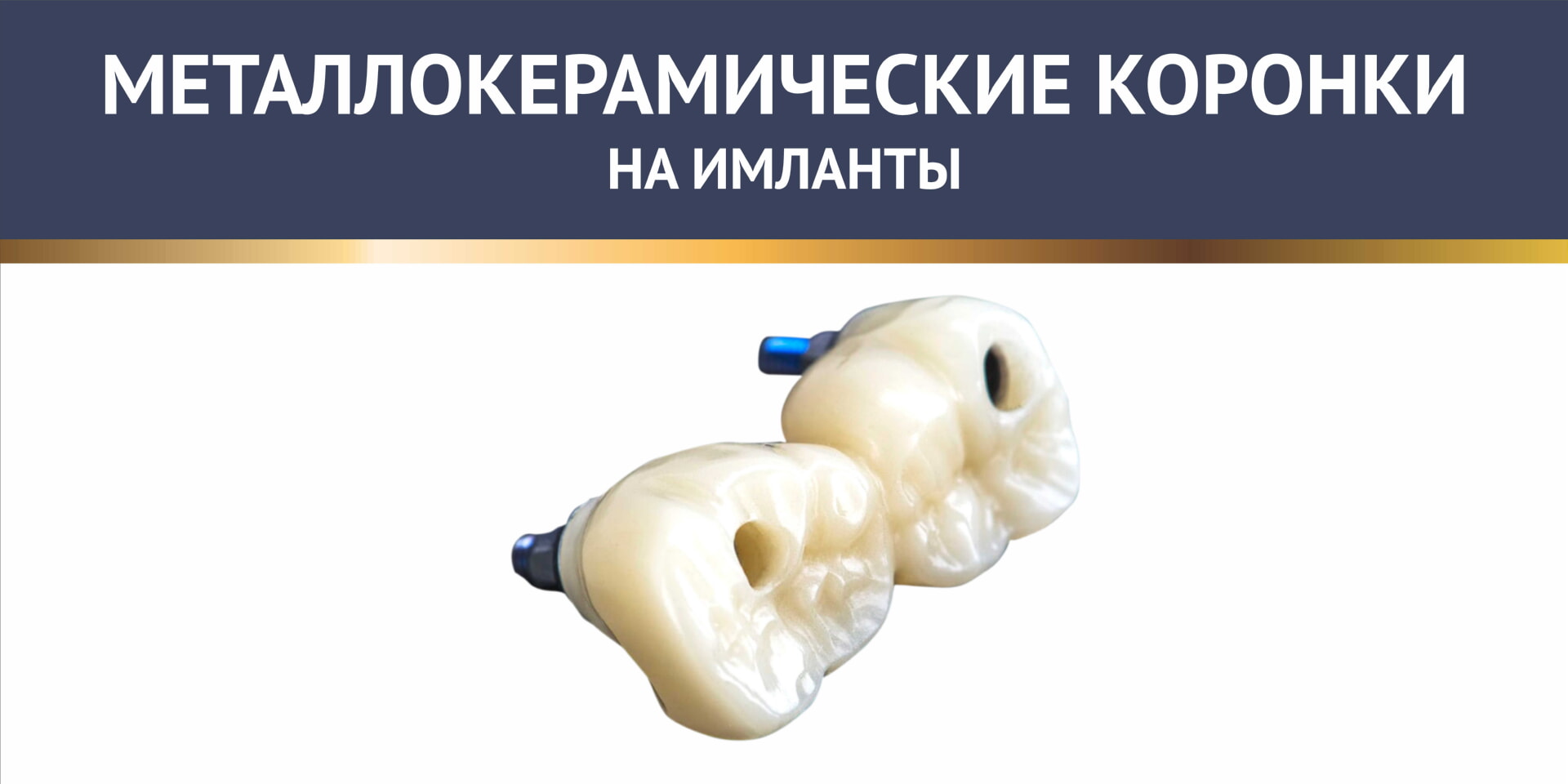 Протезирование на металлокерамических коронках