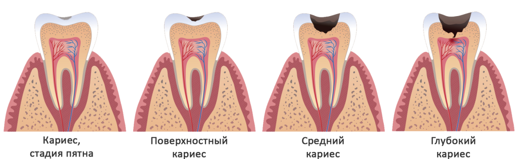 Стадии кариеса