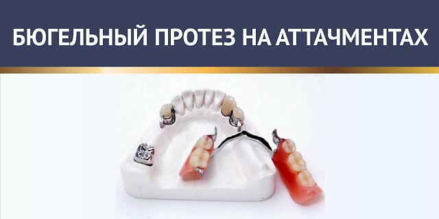 Бюгельный протез на аттачментах