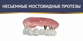 Несъёмные мостовидные протезы