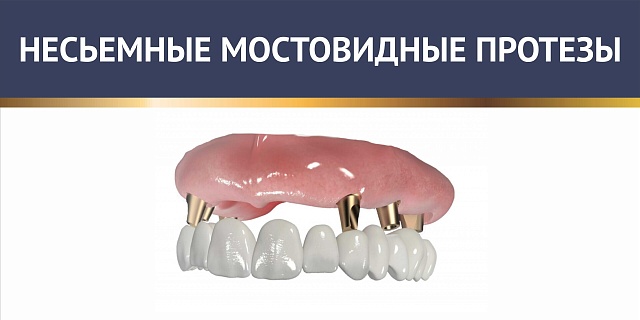 Несъёмные мостовидные протезы