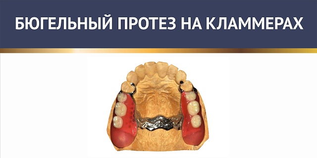 Бюгельный протез на кламмерах