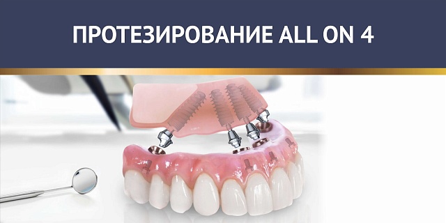 Протезирование ALL ON 4