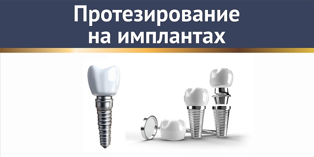Протезирование на имплантах