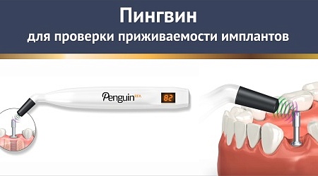 Зубы за 1 день. Уникальный прибор для оценки приживаемости имплантов Penguin RFA