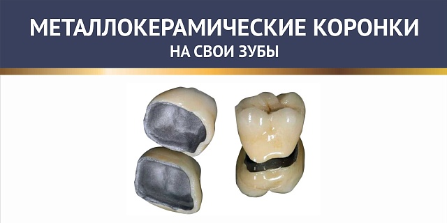 Металлокерамические коронки на своих зубах
