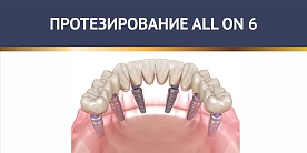 Протезирование Все на 6