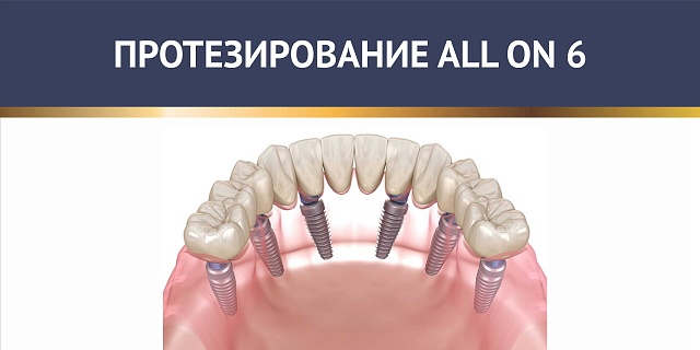 Протезирование ALL ON 6