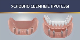 Условно съёмные протезы