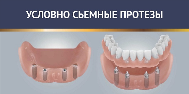 Условно съёмные протезы