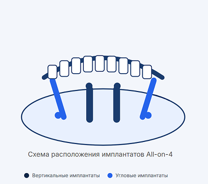 Схема расположения имплантатов All-on-4